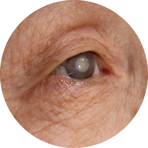 백내장 증상 - 안구혼탁