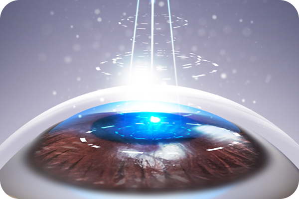 녹내장 치료방법 - 레이저치료