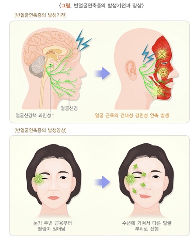 눈 떨림이 멈추지 않는다면? 반측안면경련을 의심하세요 : 두통, 수면장애, 말초신경병, 신경통증 등에 대한 의학 정보