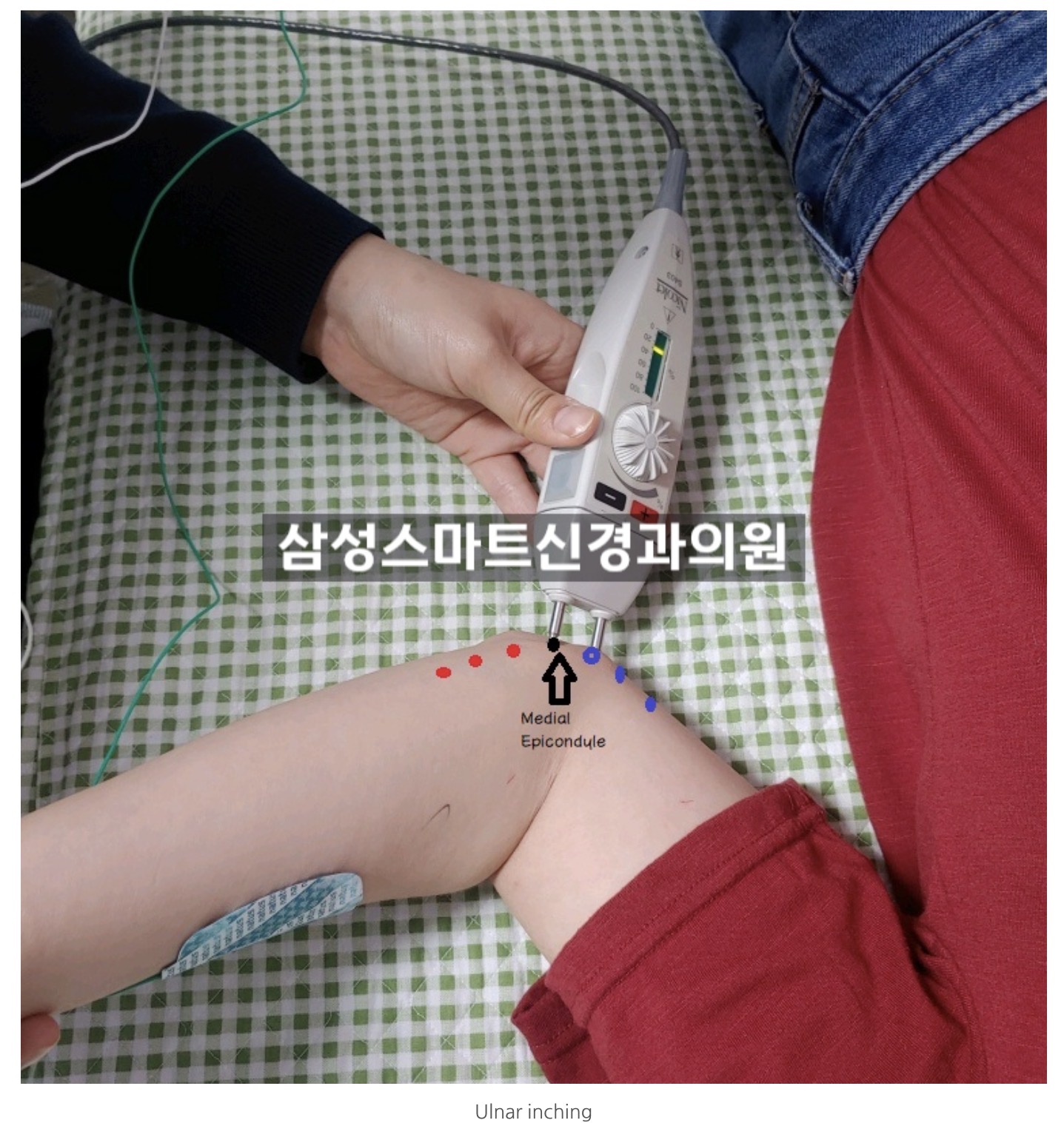 손 저림의 주범, 척골신경병증(Ulnar Neuropathy) : 삼성스마트신경과 서울점ㅣ박재현 원장