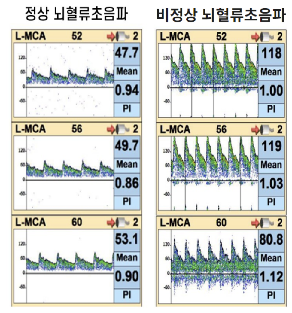 뇌혈류초음파 검사 TCD의 모든 것 : 삼성스마트신경과 서울점ㅣ박재현 원장