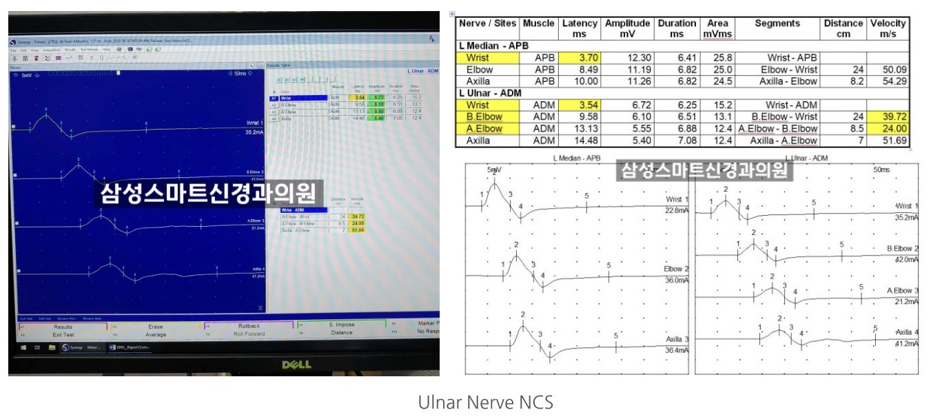 손 저림의 주범, 척골신경병증(Ulnar Neuropathy) : 삼성스마트신경과 서울점ㅣ박재현 원장