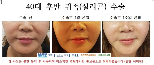 40대후반 귀족수술1.jpg