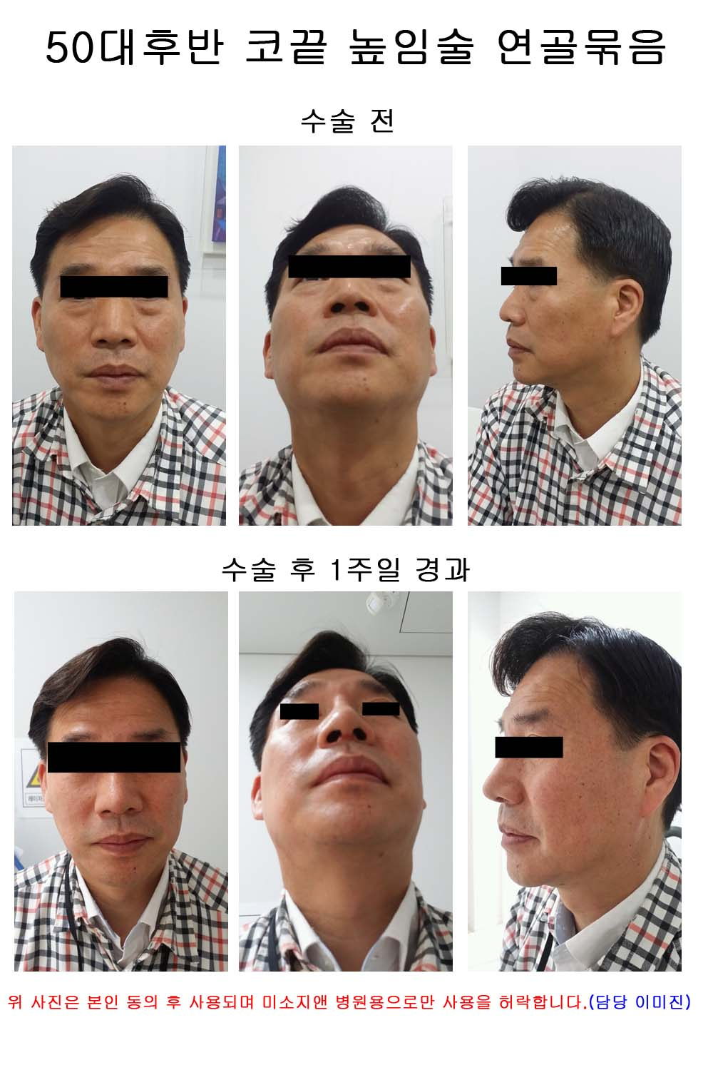 50대 코끝높임술(연골묶음).jpg