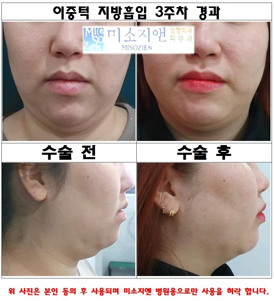 이중턱2.jpg