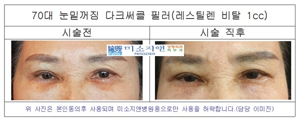 눈밑다크써클 모델.jpg