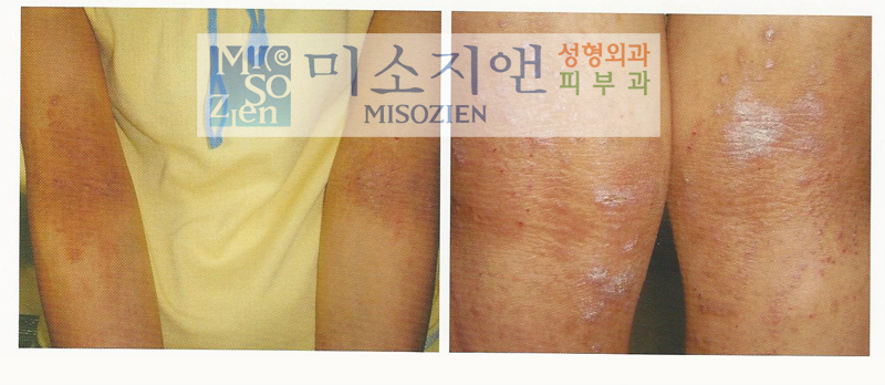 아토피3.jpg
