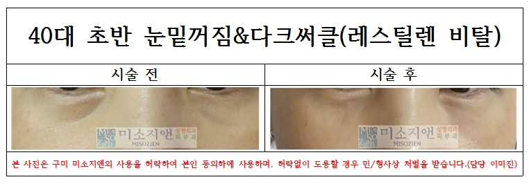 눈밑필러(비탈).jpg