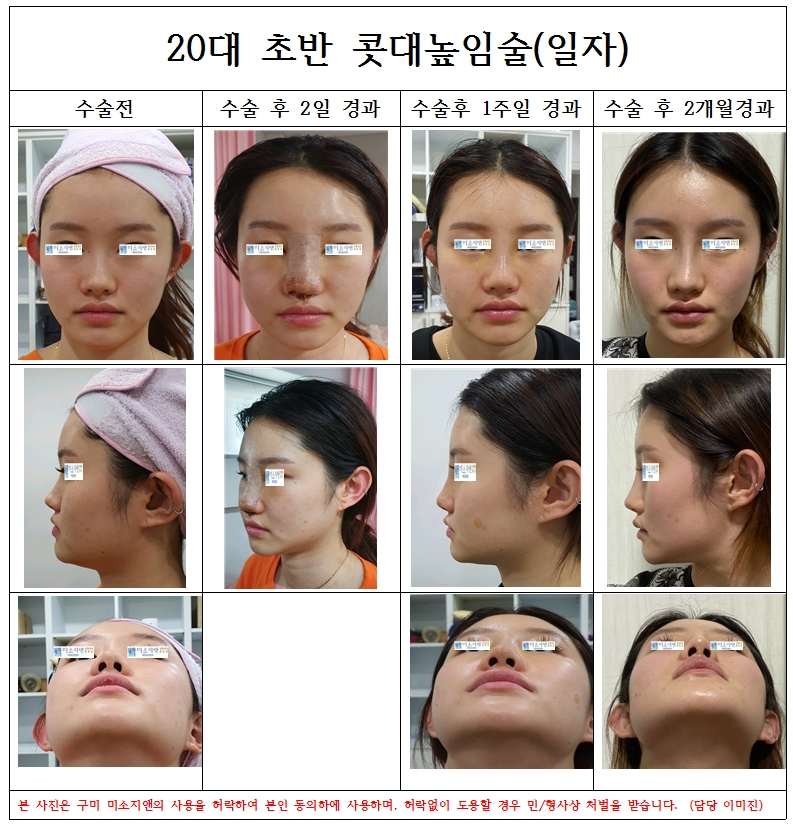 20대초반 콧대(일자)높임술1..jpg