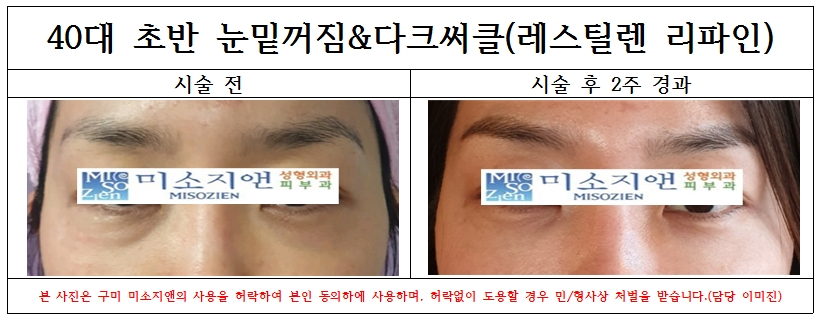 40대초반 눈밑필러(리파인).jpg