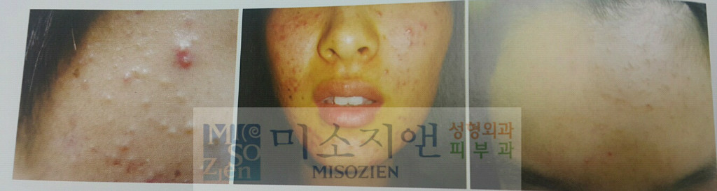 여드름1.jpg