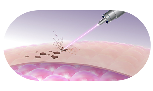 피부에 레이저를 쏘는 모습
