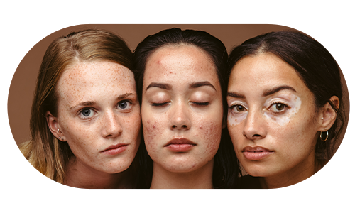 피부트러블이 일어난 여성 3명의 모습