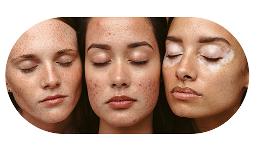 피부트러블이 있는 여성 3명의 얼굴이 모인 사진