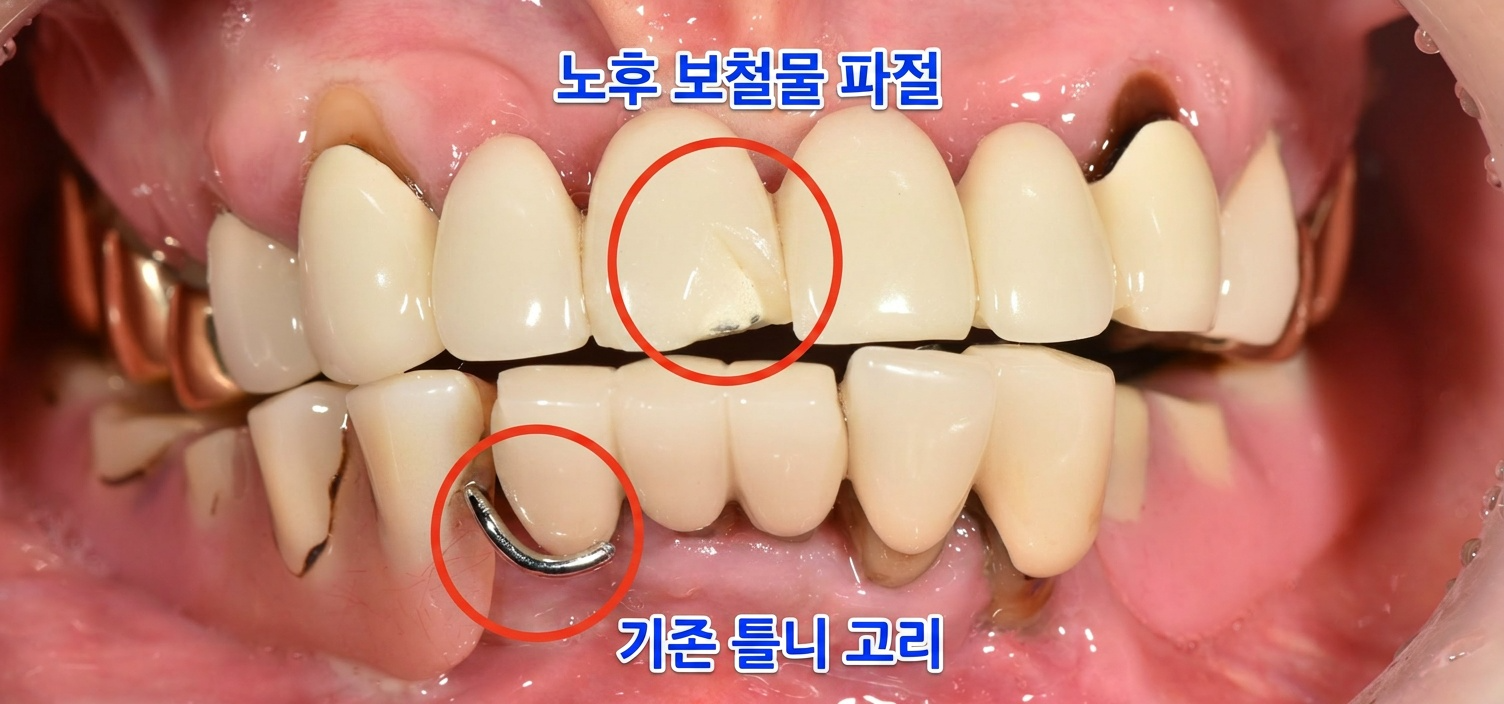 [치료 전] 최초 내원시 구내사진, 상악은 보철물 파절을 포함하여 보철물 노후 현상, 하악은 틀니의 사용불편 호소