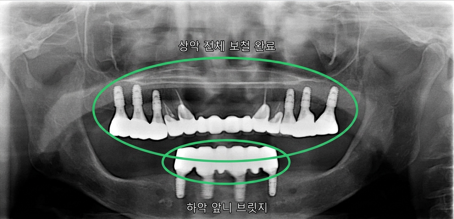 [치료 중] 상악 구치부 보철물 제작 및 장착, 상악 전치부 브릿지 보철물 제작 및 장착, 하악 전치부 임플란트 보철물 제작 및 장착