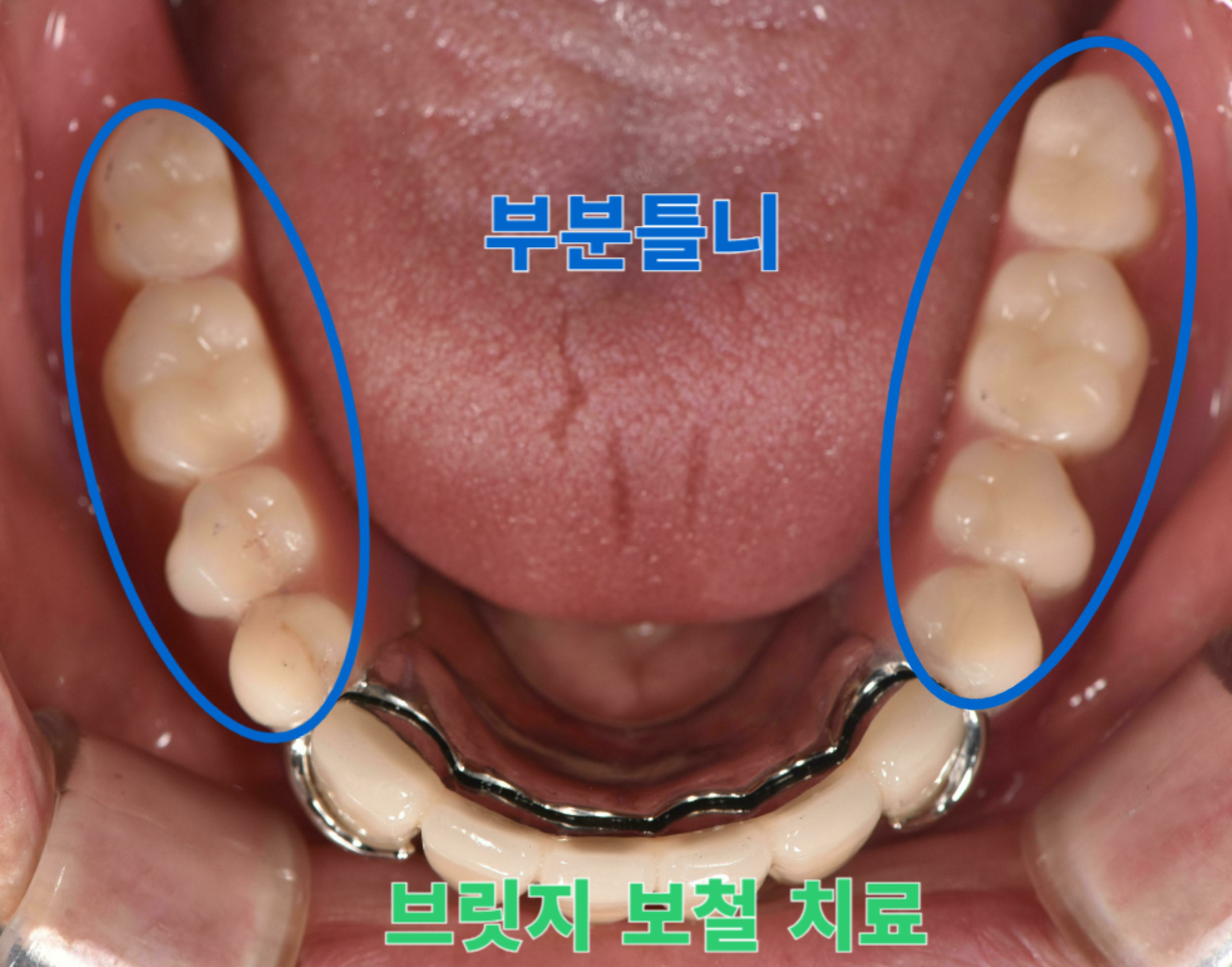 [치료 후] 치료 완료 후 구내사진(하악)