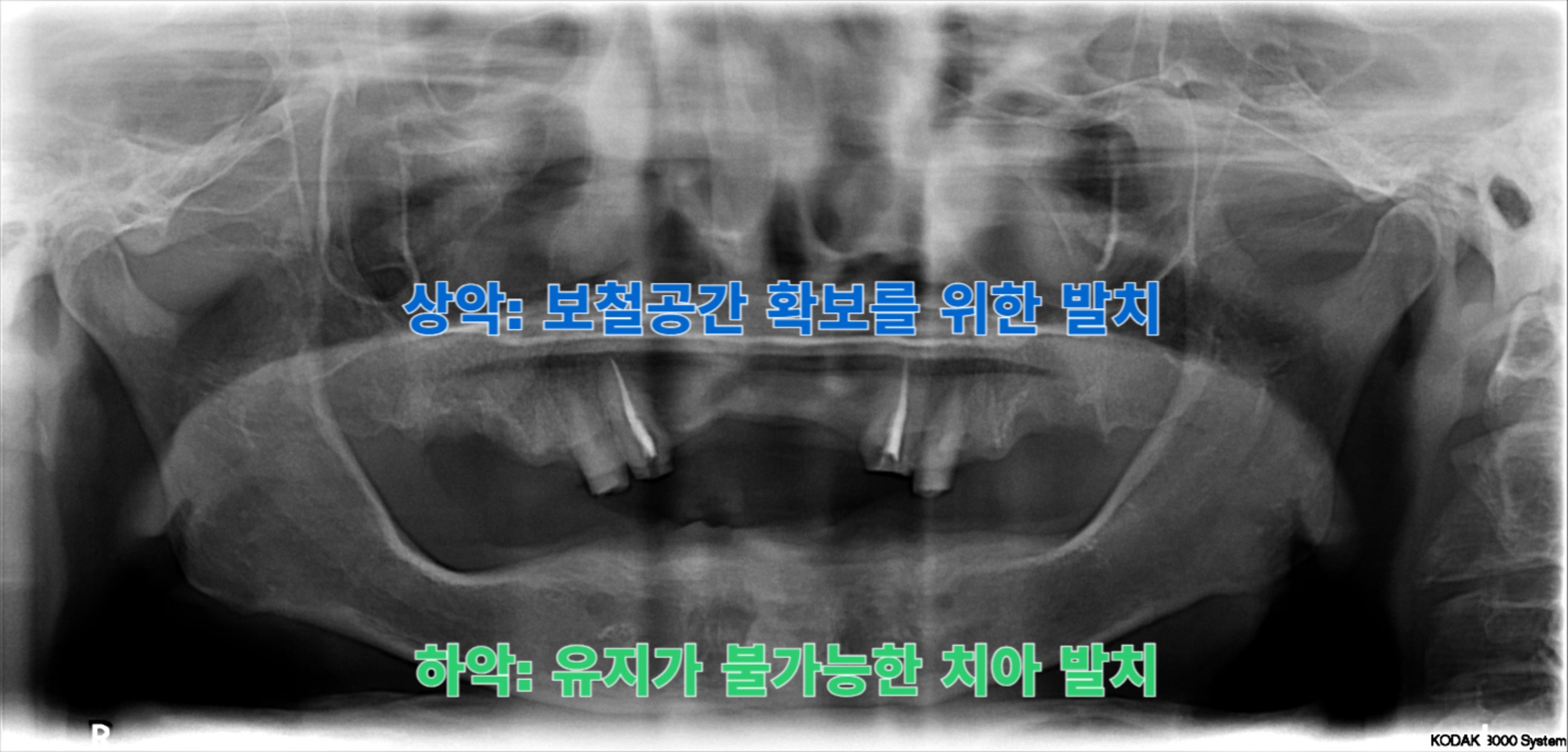 [치료 중] 하악 잔존 치아 발치, 상악도 전치부 보철의 지대주 역할을 할 치아를 제외하고 발치