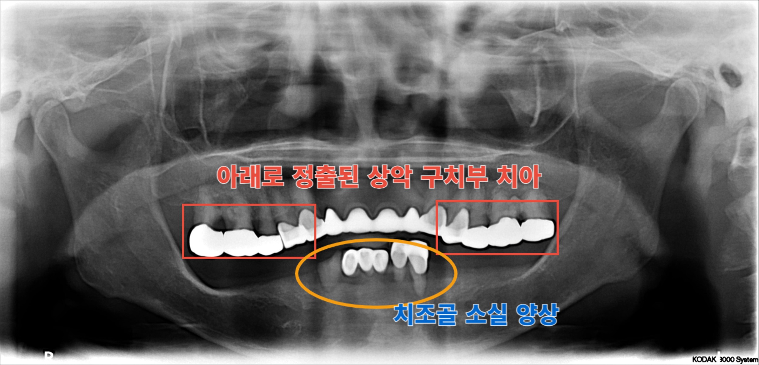 [치료 전] 최초 내원시 방사선 사진, 상악의 경우 보철물 하방으로 치아우식 및 치주염 발생하여 다수 치아 발치 필요상태. 하악의 경우 치조골 소실이 심하여 치아 유지가 어려운 상태로 판단됨