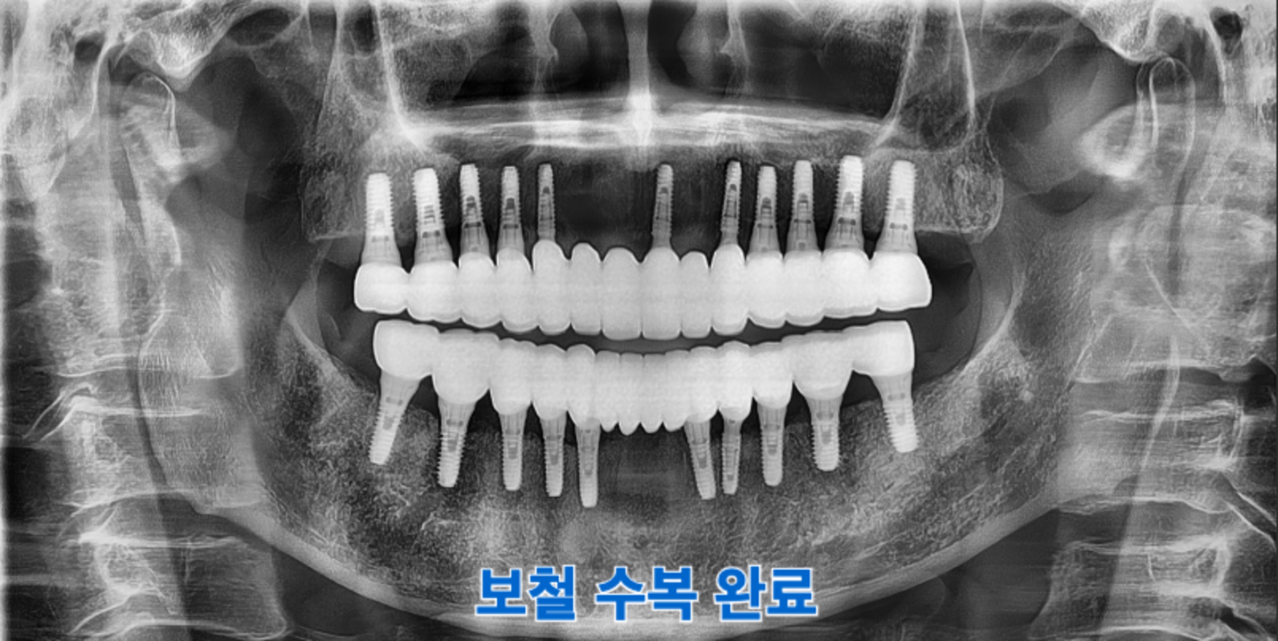 [치료 후] 치료 종결 후 파노라마