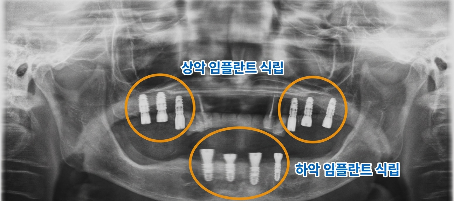 [치료 중] 상악 구치부 및 하악 전치부 임플란트 식립