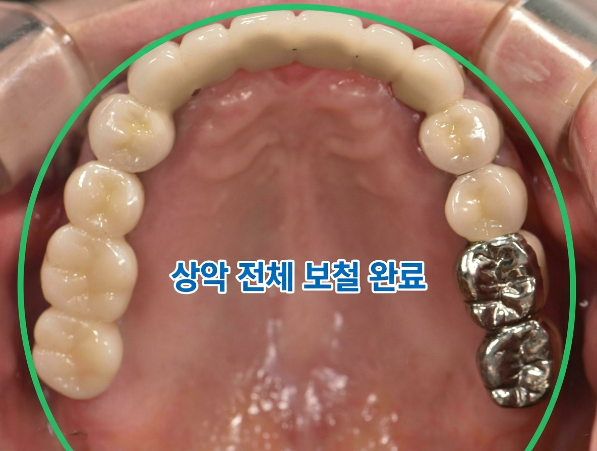 [치료 후] 치료 완료 후 구내 사진(상악)