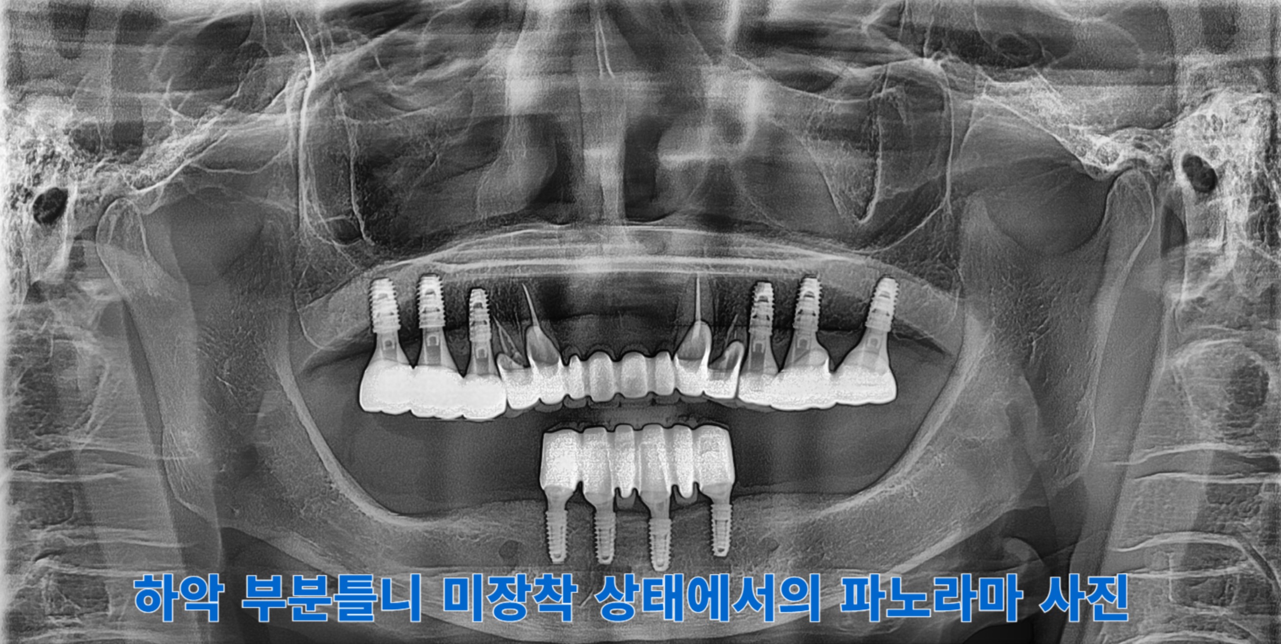[치료 후] 체크업시 잘 유지되고 있는 모습