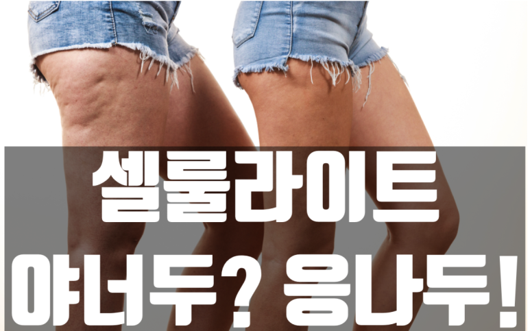 셀룰라이트 이미지