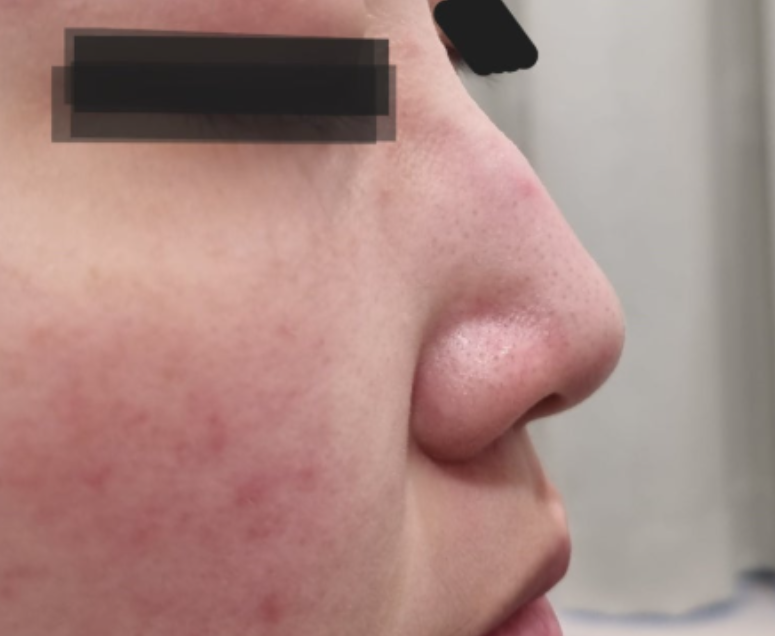 ウィジュンブフィラー