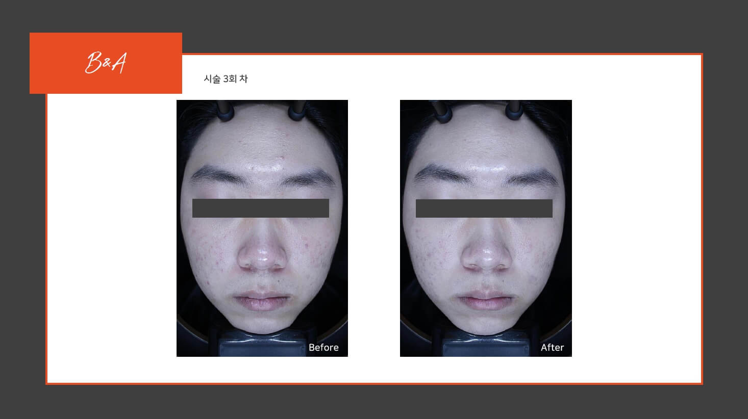 원주여드름관리 전후사진