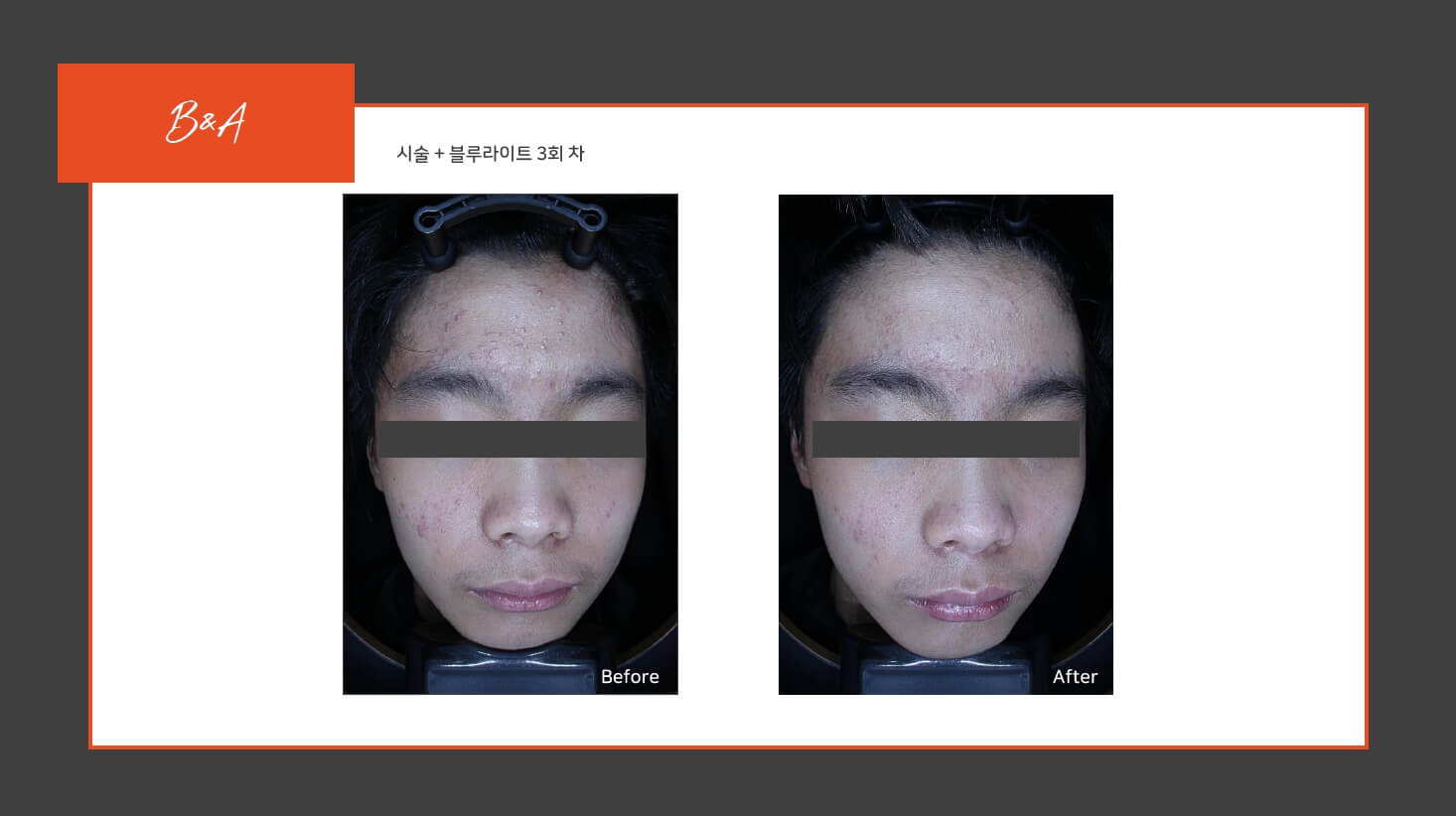 여드름 라라샷