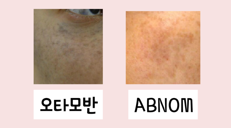 노원 기미치료! 피코토닝, 나노토닝 중 정답은? : 노원점 시술 안내