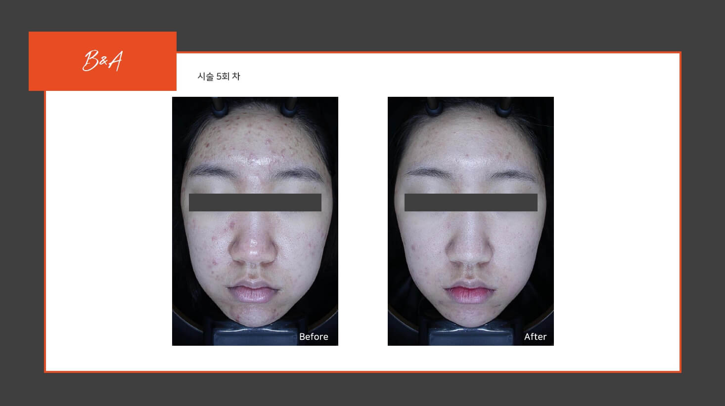 원주피부관리 전후사진