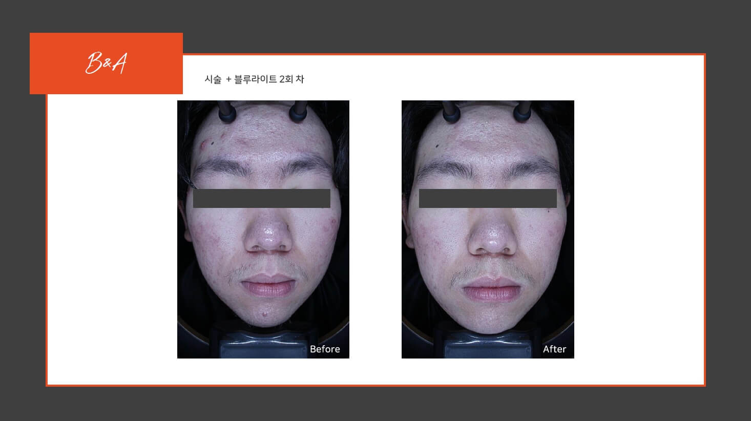 원주여드름관리 비포에프터