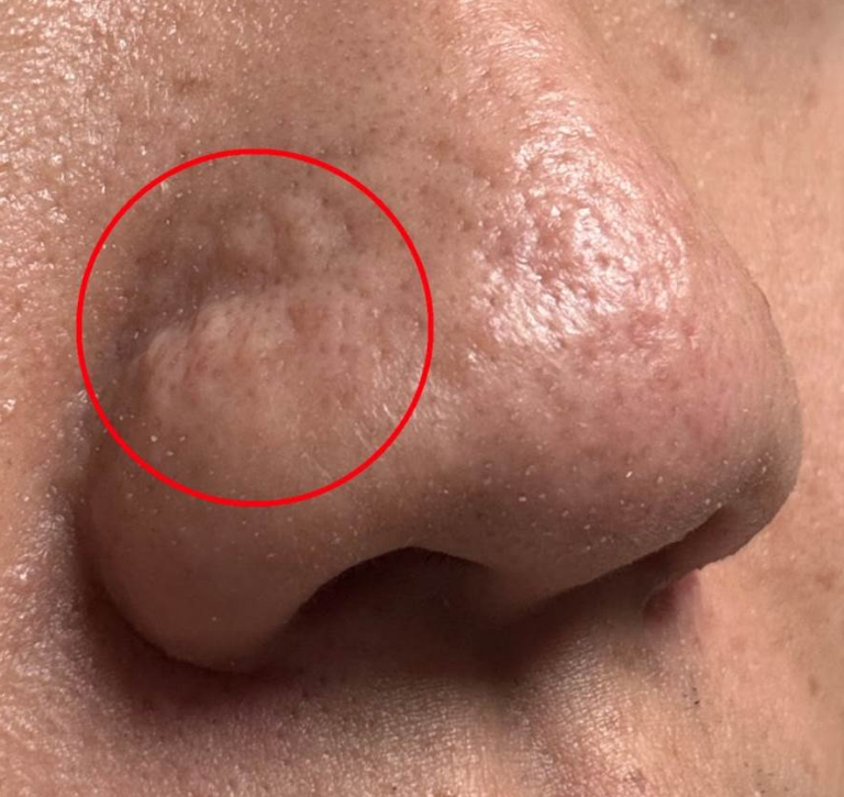 Acne scars