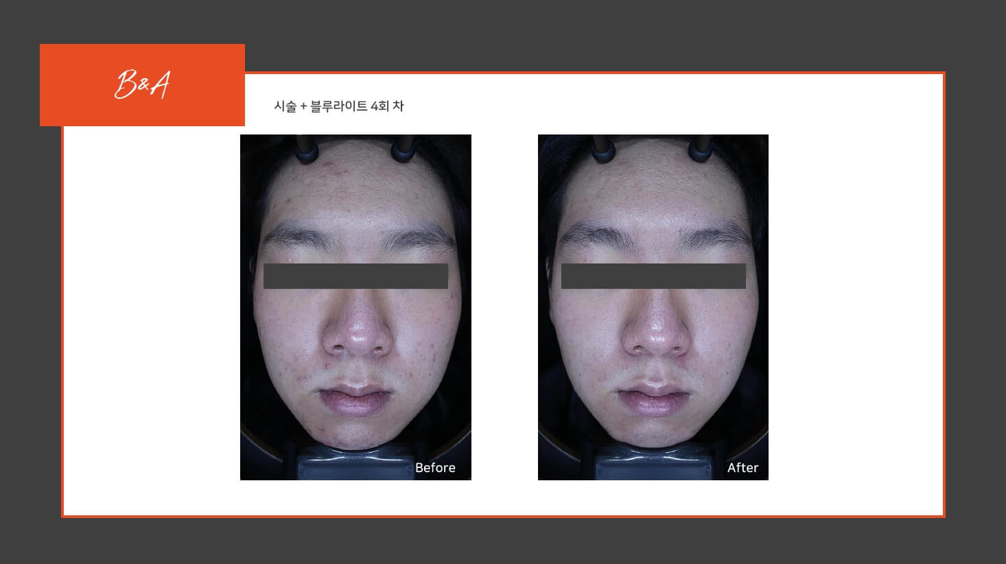 원주피부관리 비포에프터