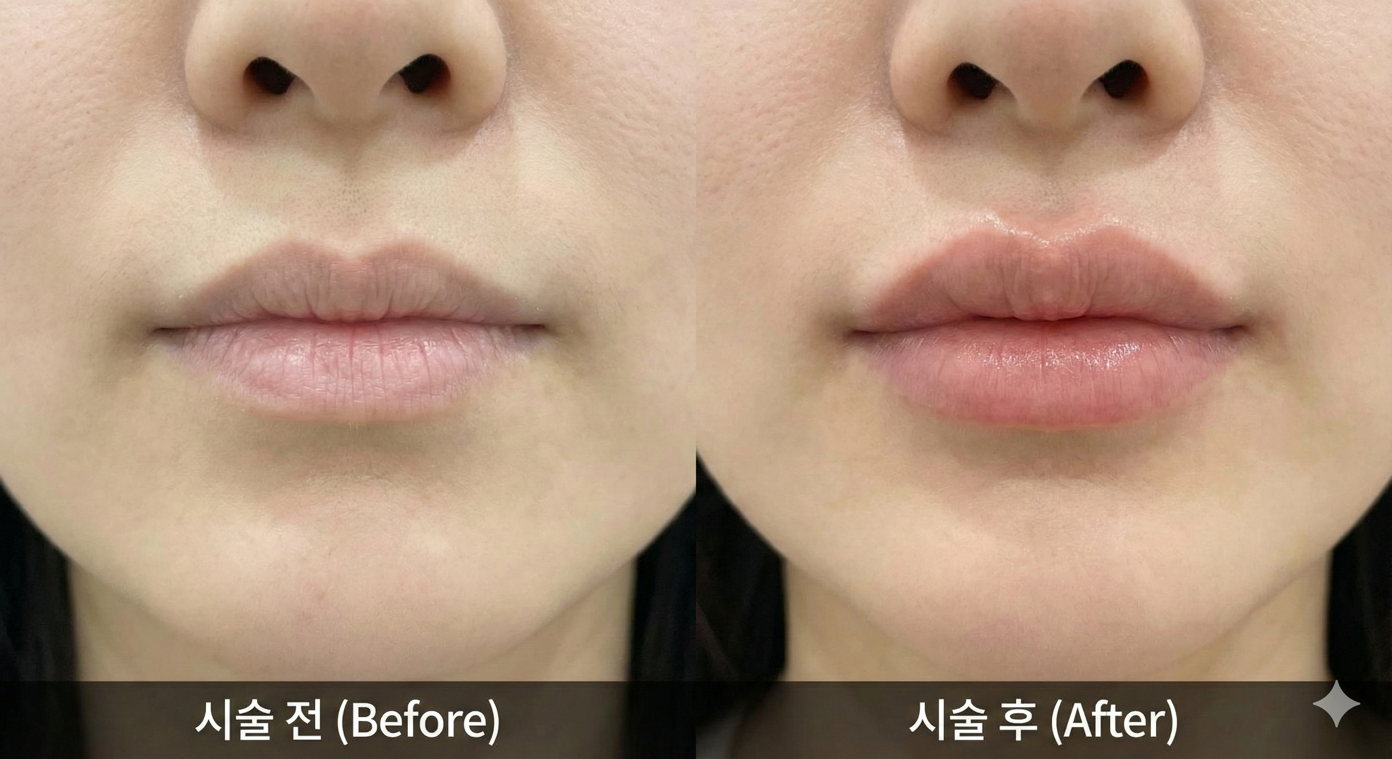 Hyaluronic Acid Fillers
