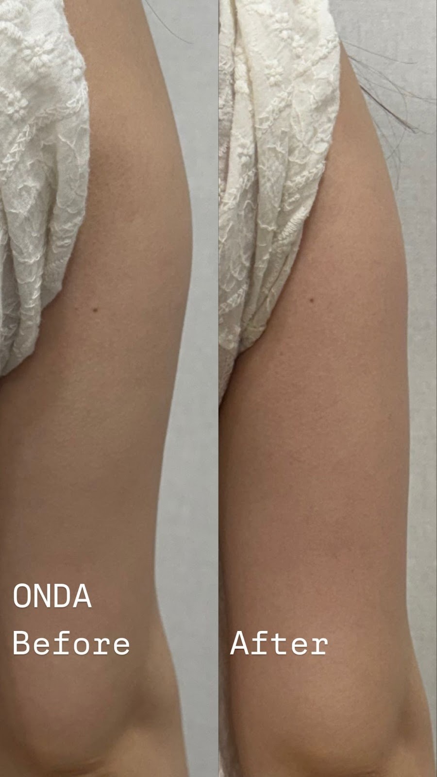 온다리프팅 바디 전후