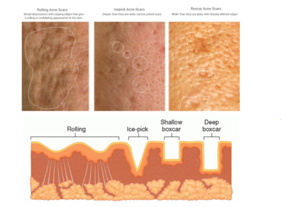 Acne scars