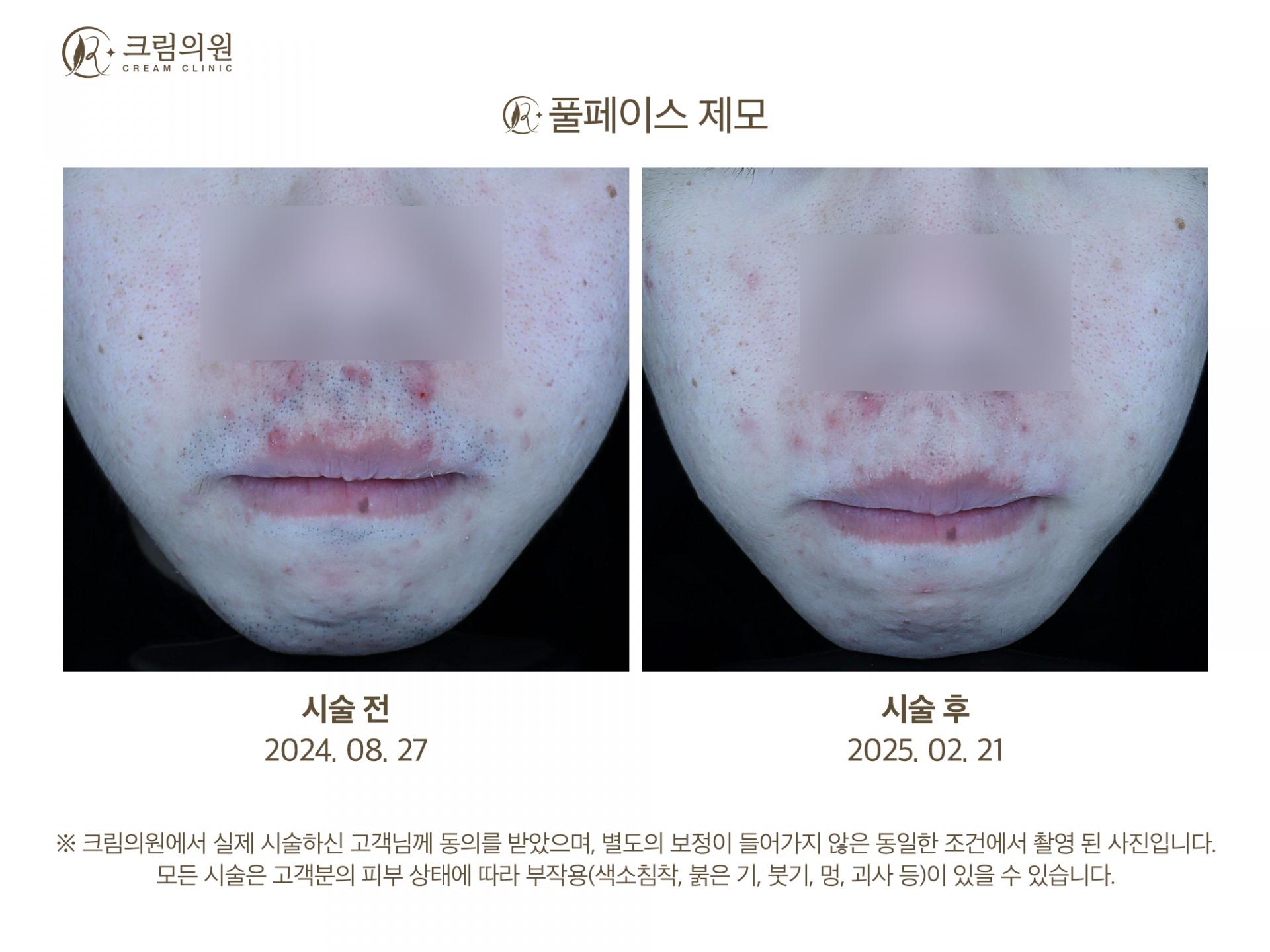 레이저제모 이미지