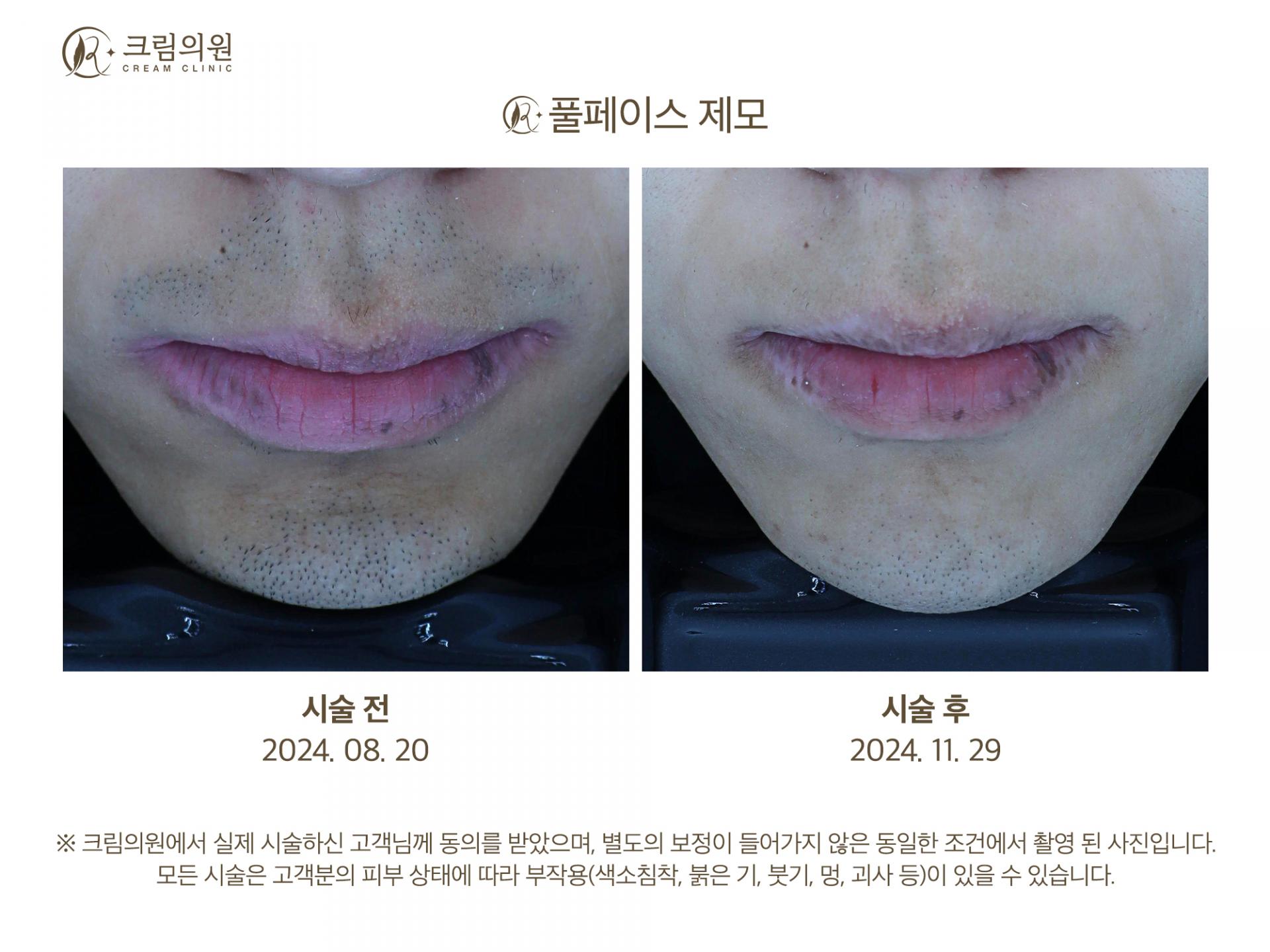 레이저제모 이미지