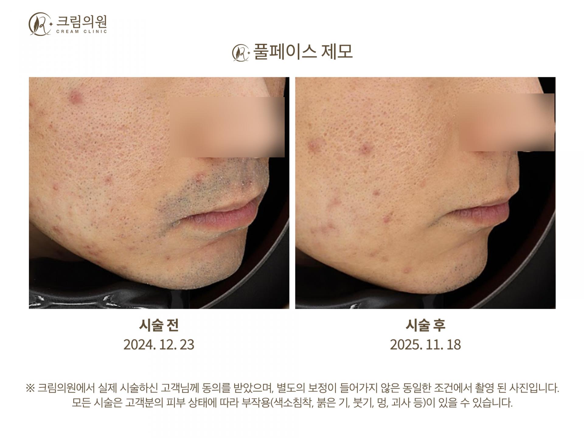 레이저제모 이미지