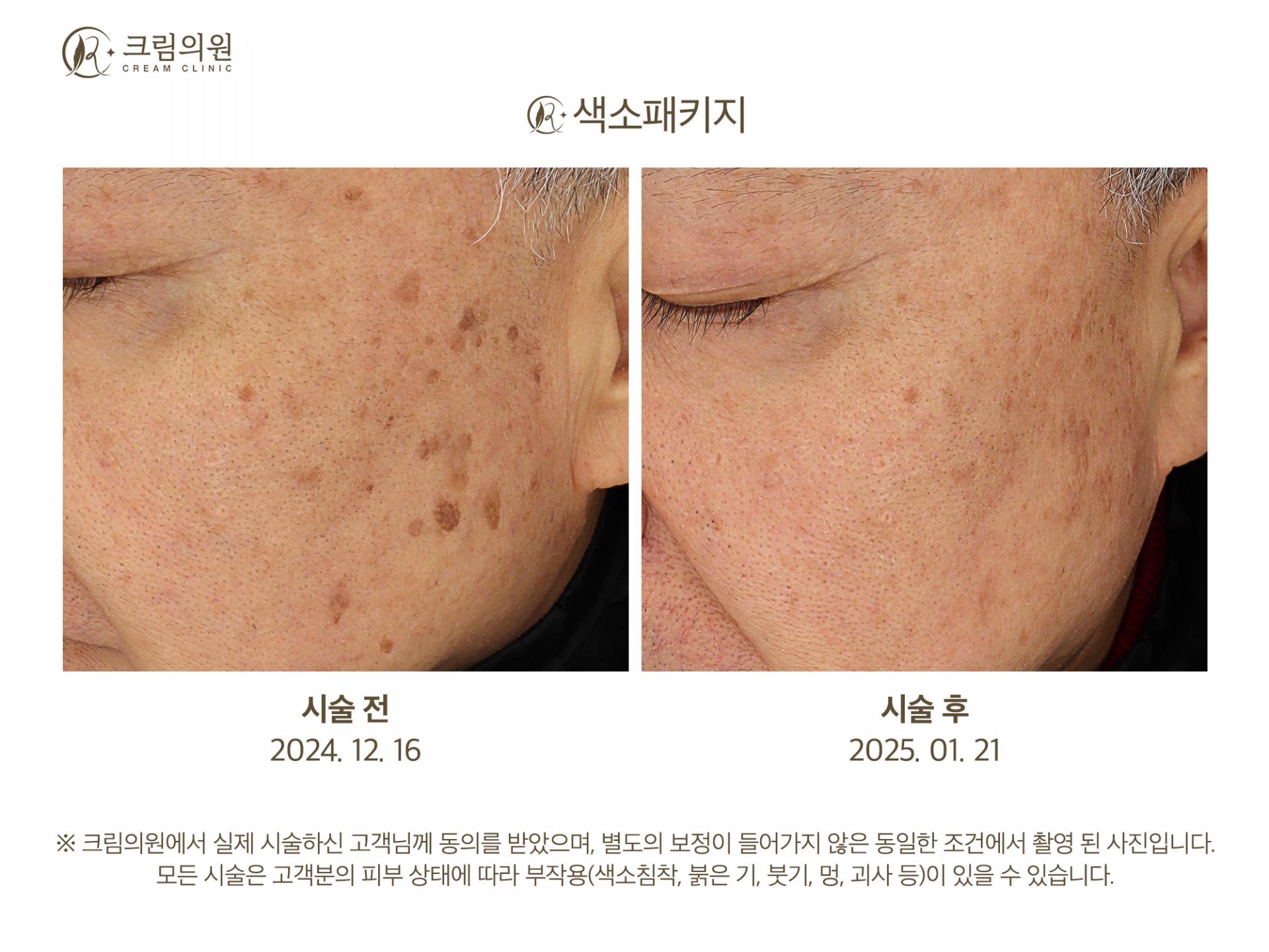 색소패키지 이미지