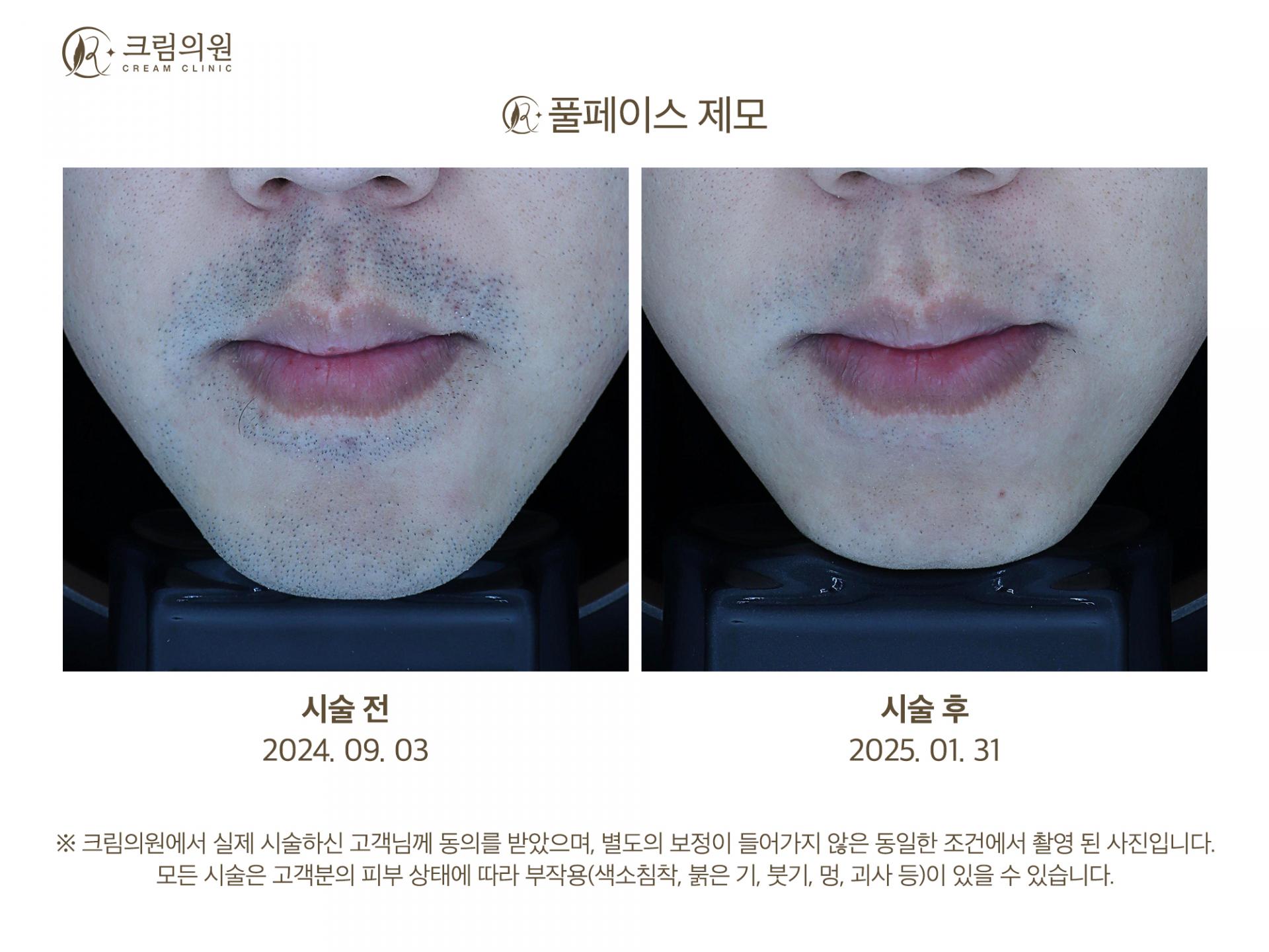 레이저제모 이미지