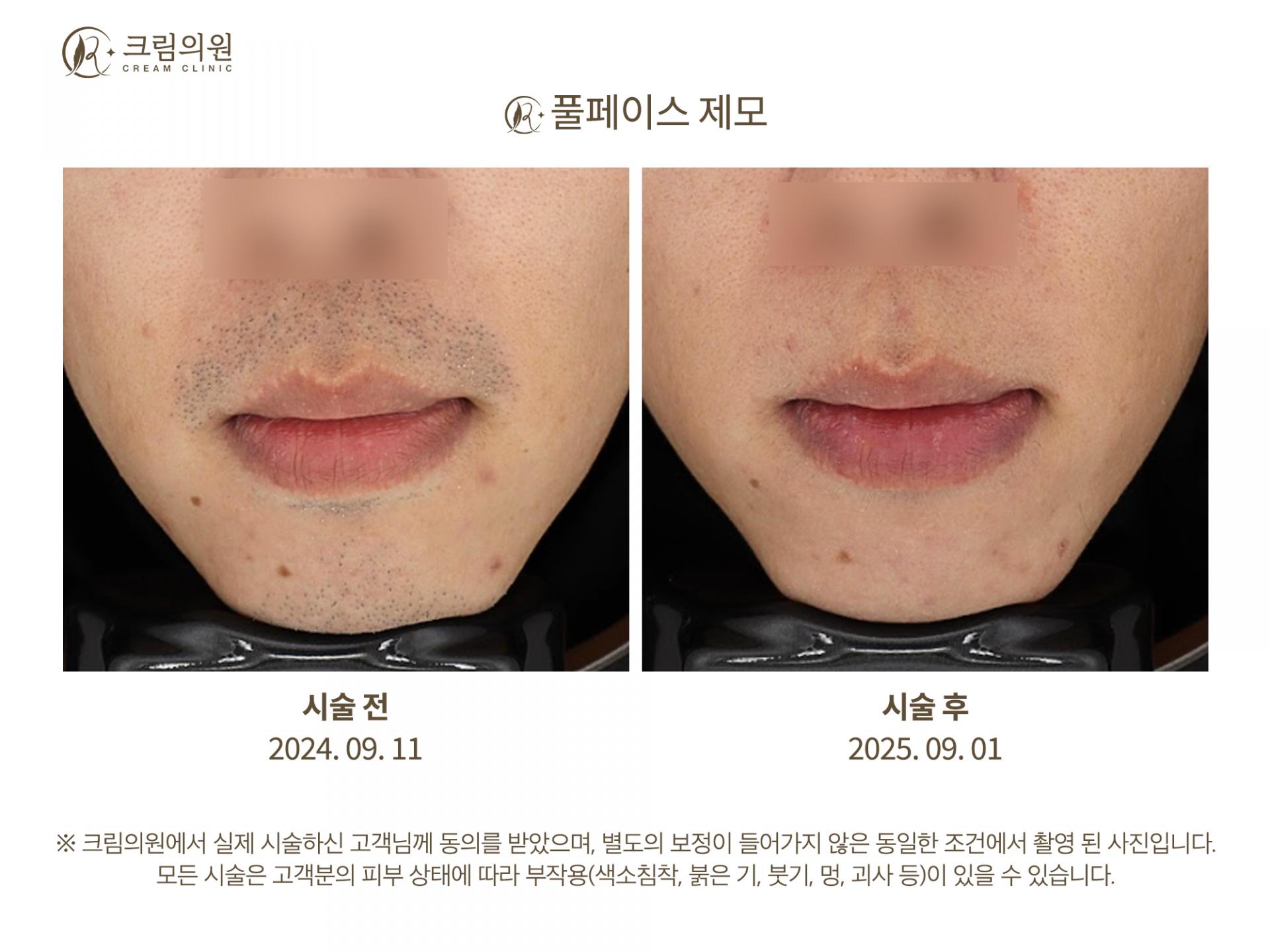 레이저제모 이미지