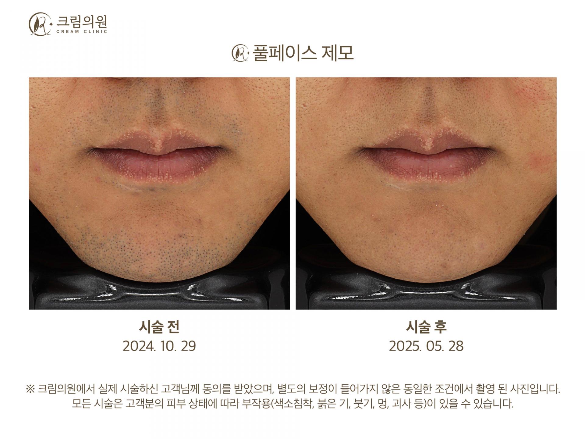 레이저제모 이미지