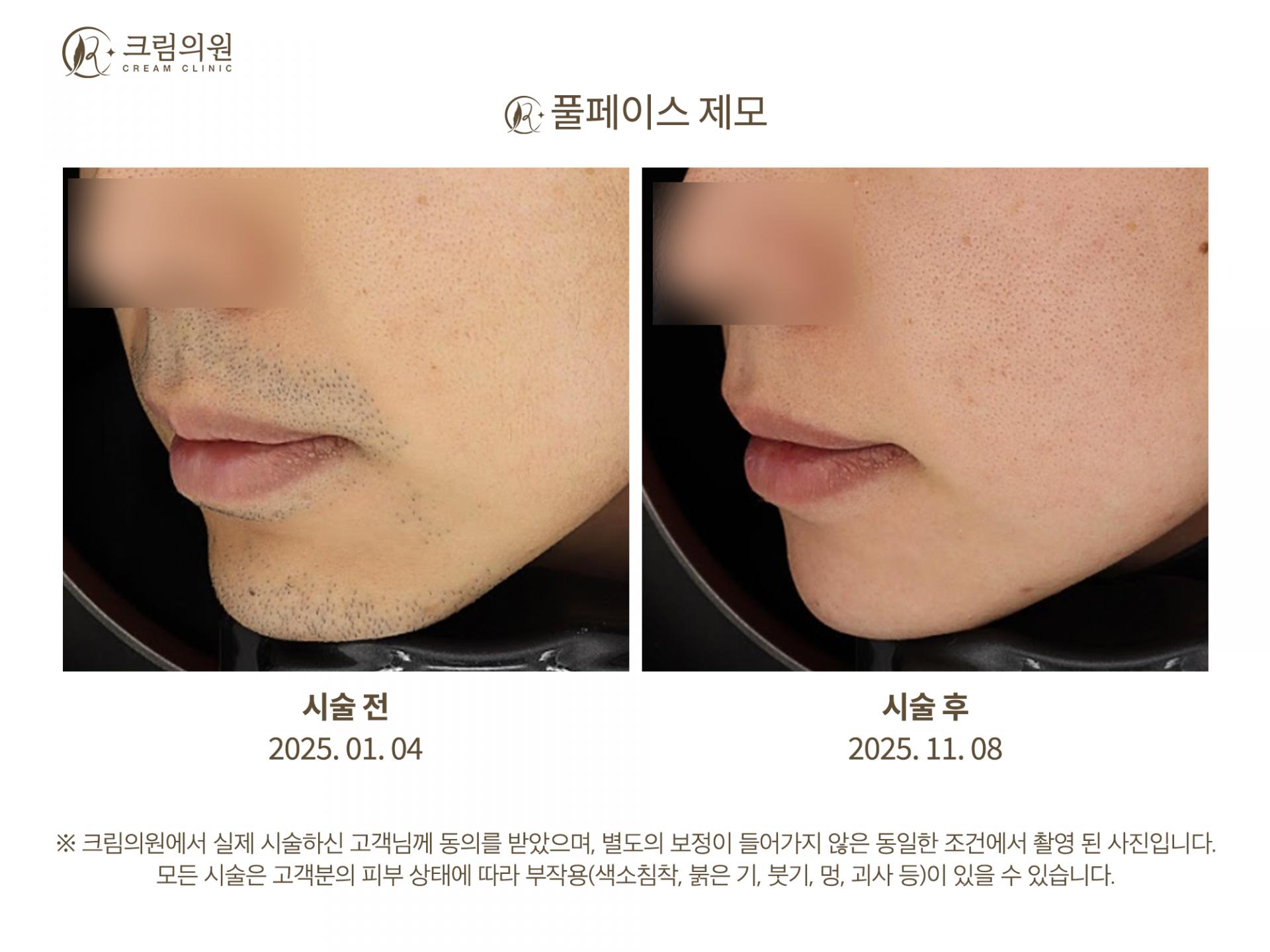 레이저제모 이미지