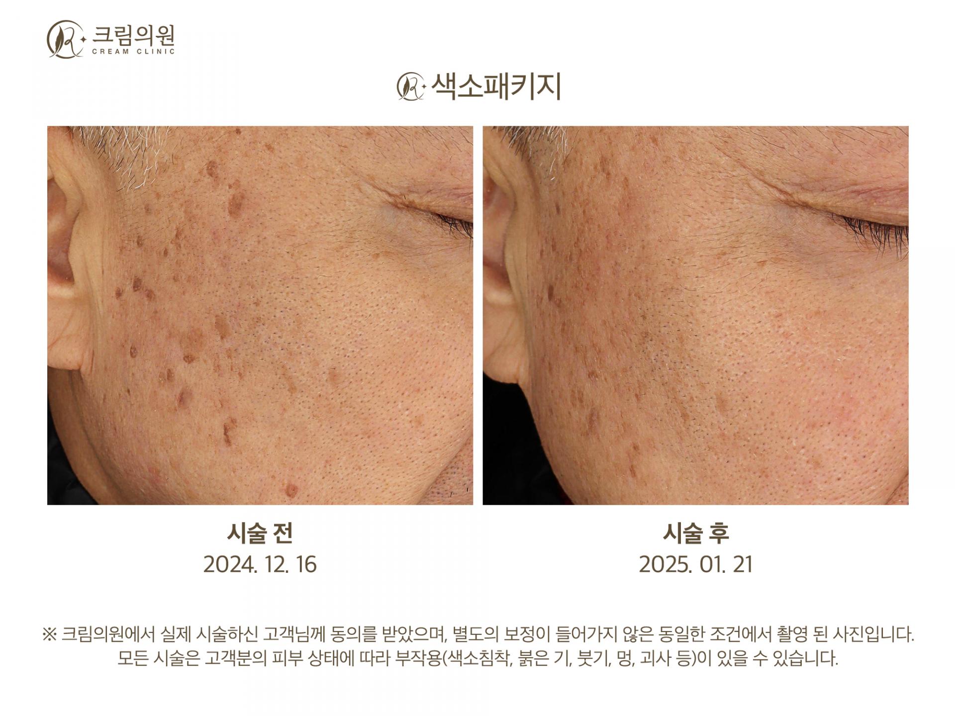 색소패키지 이미지