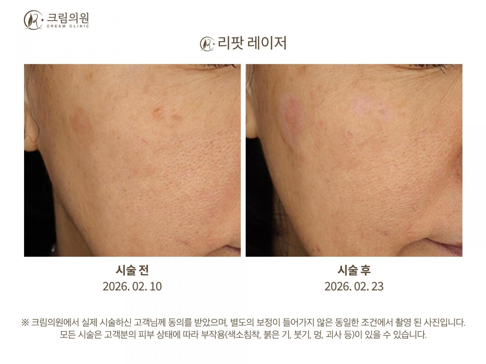 색소패키지 이미지