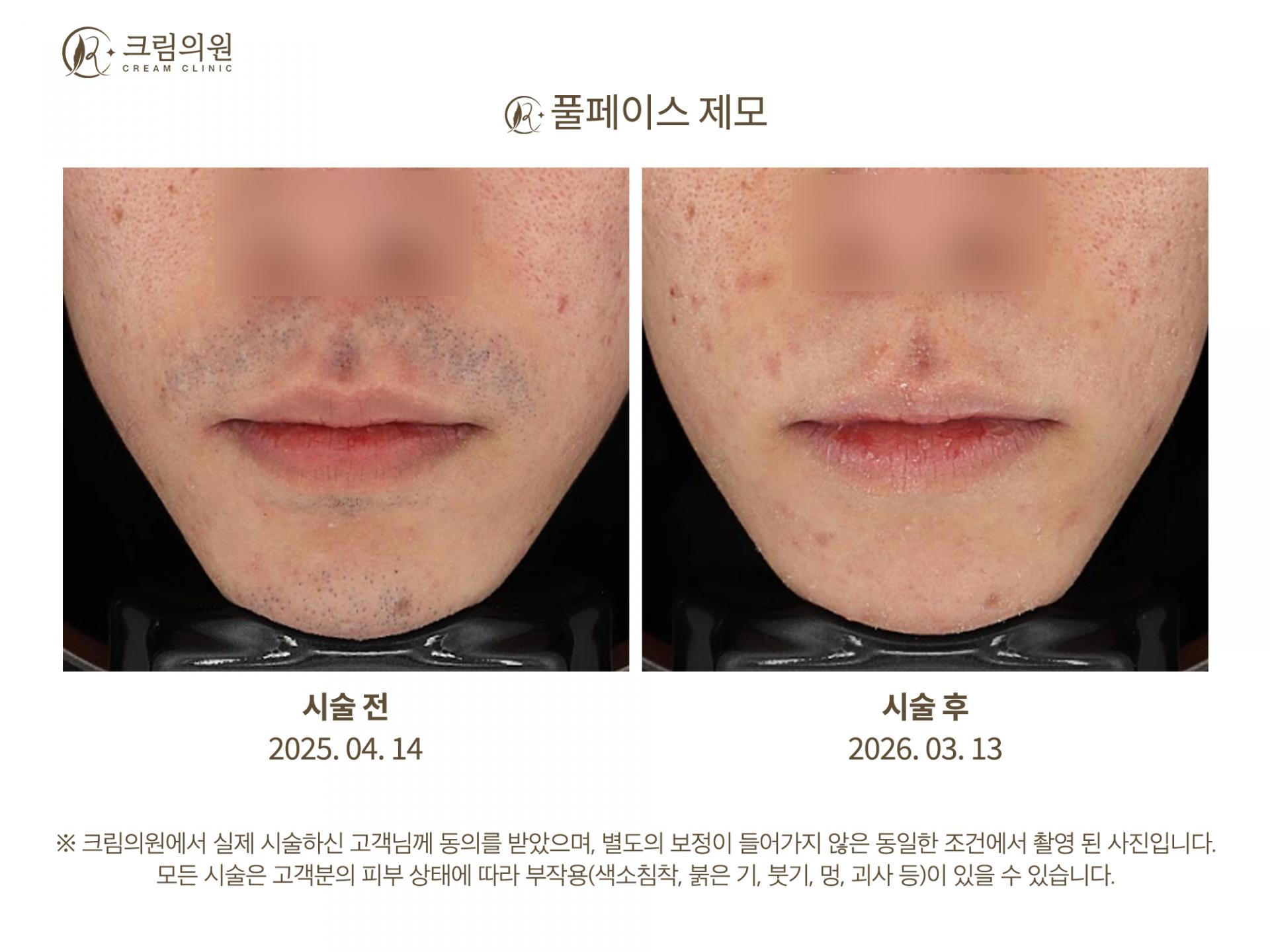 레이저제모 이미지